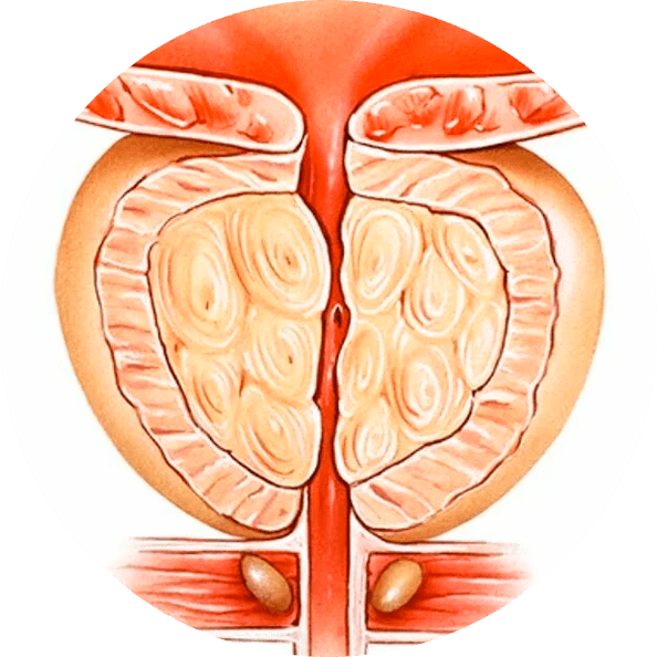 Consequences of untreated prostatitis